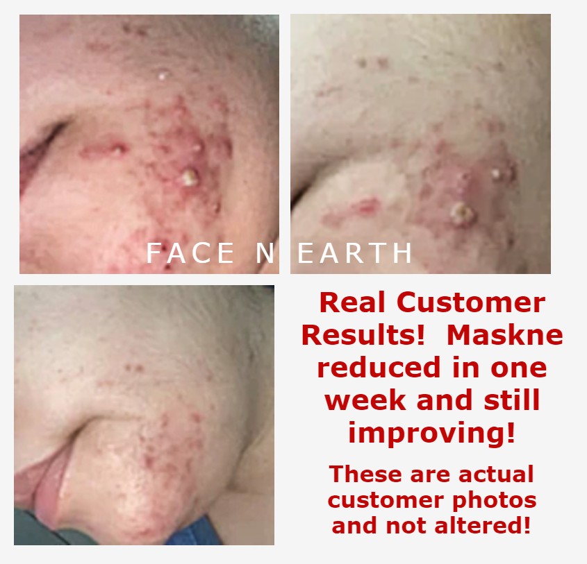 Blemish Comfort Serum - SPECIAL PRICE - Facenearth